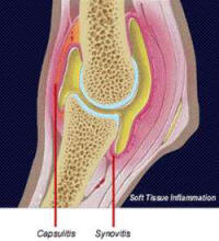 Magnets and Inflammation